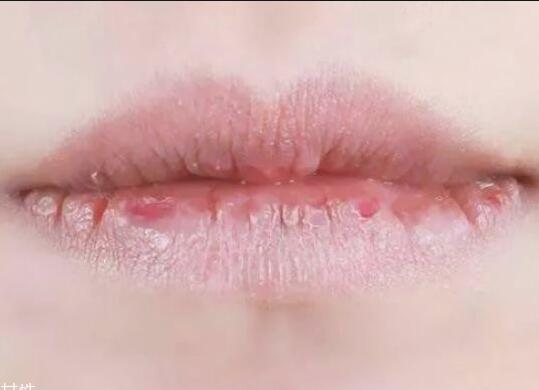 紋唇后嘴巴干燥怎么辦？南寧教紋繡的學(xué)校幫你解決