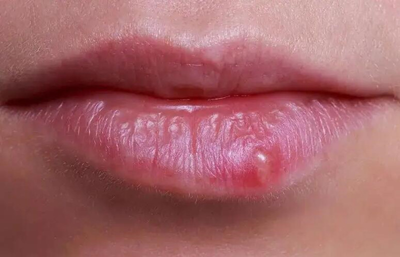 紋唇后起泡怎么辦？南寧紋唇培訓學校教你方法