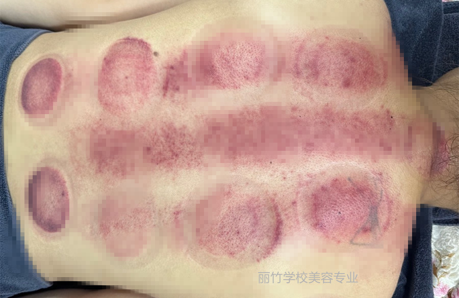 拔火罐的顏色代表什么？南寧美容美體專業(yè)實訓(xùn)