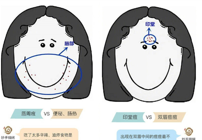 南寧皮膚管理學校排名：臉上不同部位長痘的原因及改善方法